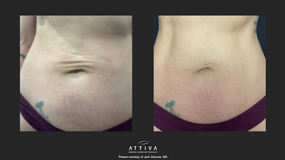 ATTIVA IRF Skin TIghtening