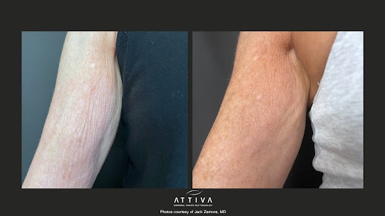ATTIVA IRF Skin TIghtening