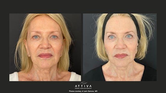 ATTIVA IRF Skin TIghtening