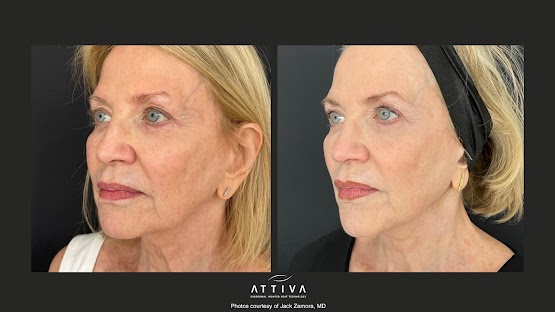 ATTIVA IRF Skin TIghtening