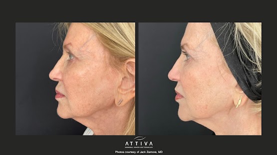 ATTIVA IRF Skin TIghtening