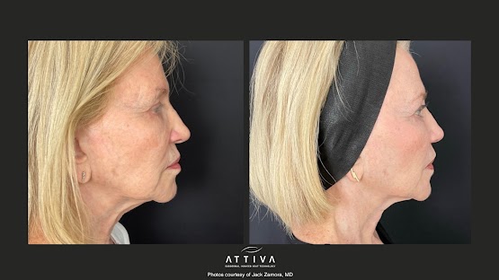 ATTIVA IRF Skin TIghtening