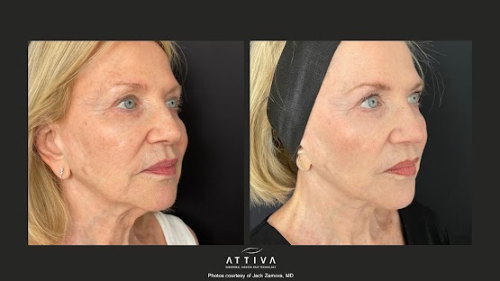 ATTIVA IRF Skin TIghtening