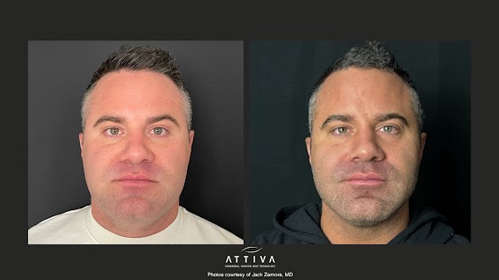 ATTIVA IRF Skin TIghtening