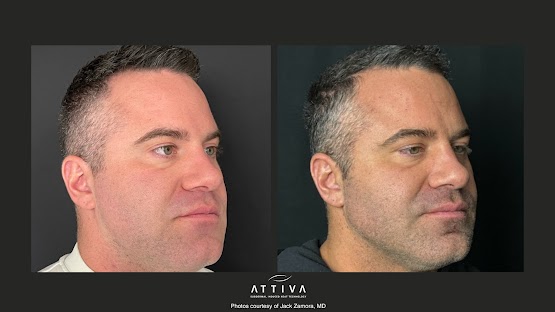 ATTIVA IRF Skin TIghtening