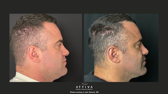 ATTIVA IRF Skin TIghtening