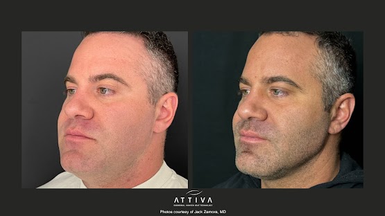 ATTIVA IRF Skin TIghtening