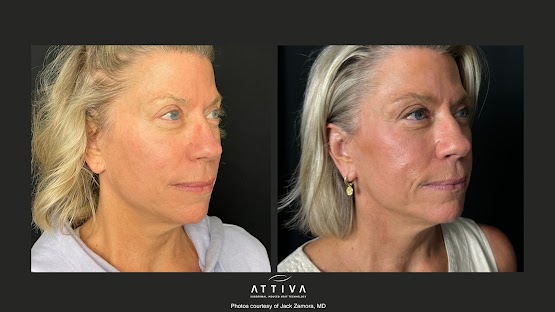 ATTIVA IRF Skin TIghtening