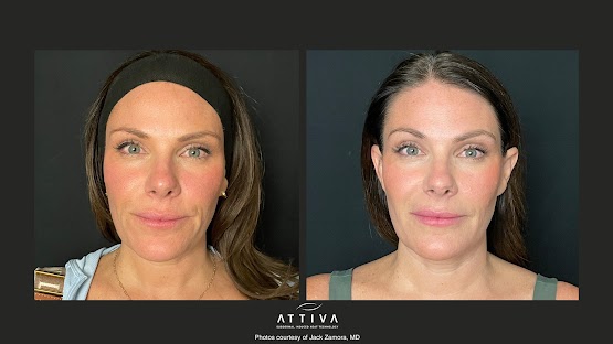ATTIVA IRF Skin TIghtening