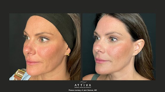 ATTIVA IRF Skin TIghtening