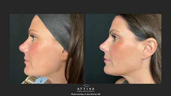 ATTIVA IRF Skin TIghtening