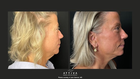 ATTIVA IRF Skin TIghtening