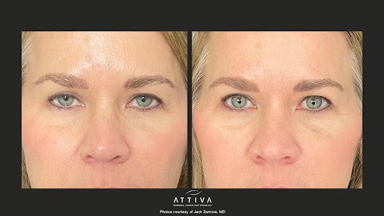 ATTIVA IRF Skin TIghtening
