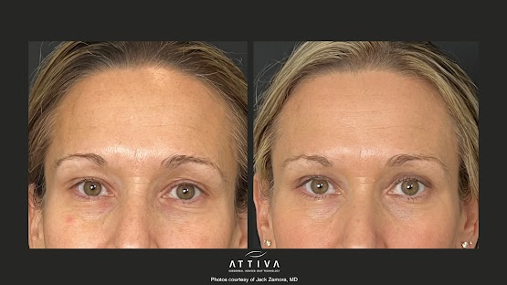 ATTIVA IRF Skin TIghtening