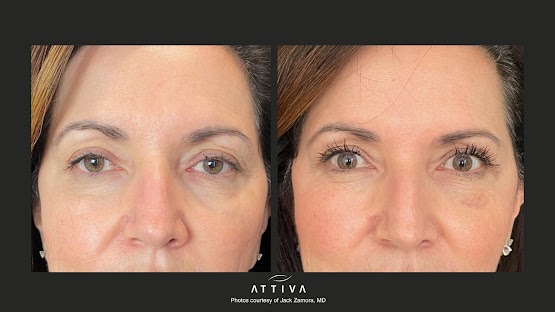 ATTIVA IRF Skin TIghtening